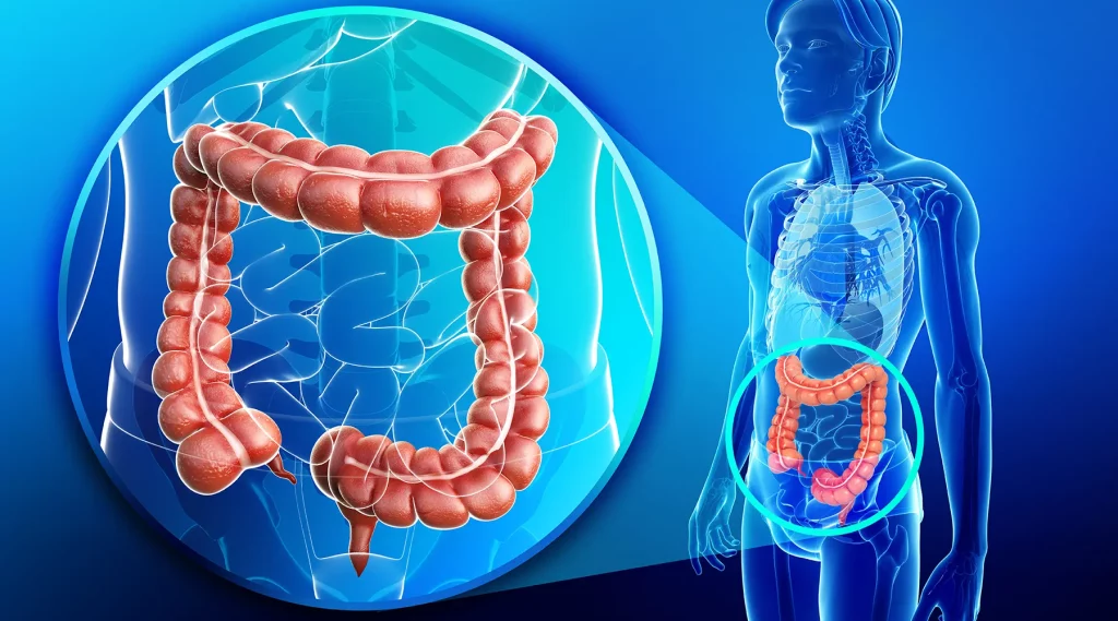 Bowel Cancer
